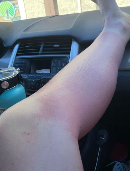 My leg on the dashboard of a parked car after being badly sunburnt.